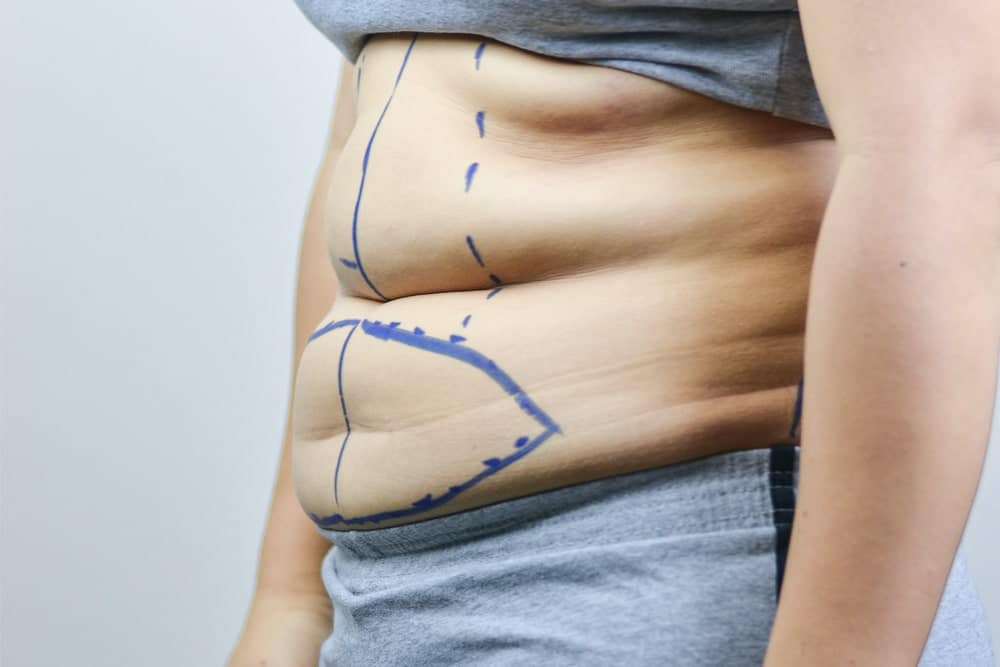 CoolSculpting PAH: The Paradoxical Adipose Hyperplasia Side Effect