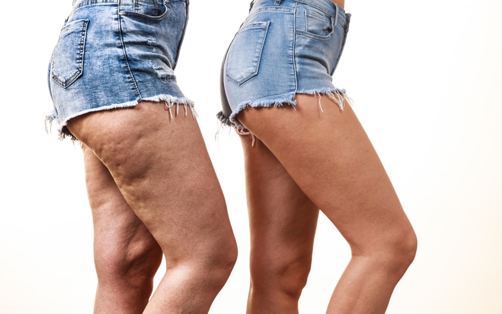 What Is Cellulite?