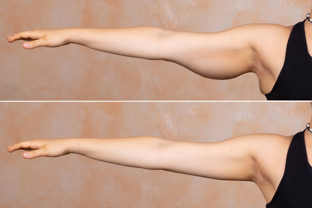 Here's How to Get Rid of Flabby Arms & Bat Wings For Good