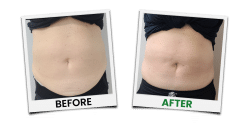 Before and after image from laser liposuction