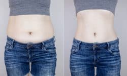 Side-by-side view of a woman's torso showing fat reduction around the midriff.