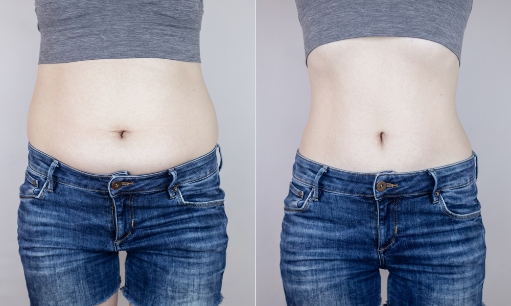 Side-by-side view of a woman's torso showing fat reduction around the midriff.